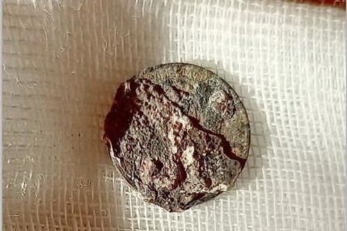 Kinh hoàng chuyện 'sống chung' với đồng xu mắc kẹt trong mũi hơn nửa thế kỷ