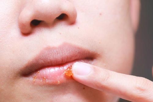 Tẩy da chết cho môi với mật ong và dầu dừa