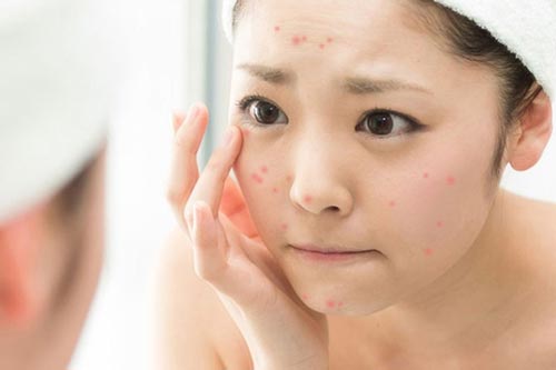 Xóa sạch sẹo mụn chỉ với nghệ