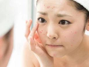 Xóa sạch sẹo mụn chỉ với nghệ