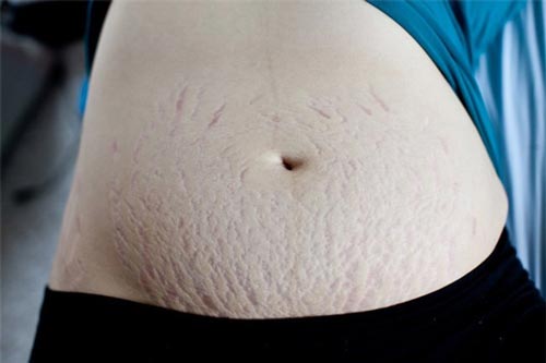 'Độc chiêu' giúp bạn trị rạn da cực nhanh