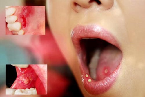 Chữa nhiệt miệng không cần tới thuốc tây khỏi sau 1 đêm