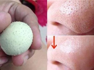 Sạch mụn đầu đen chỉ bằng cách dùng trứng gà