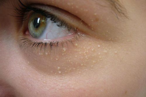 2 cách trị mụn thịt đơn giản tại nhà