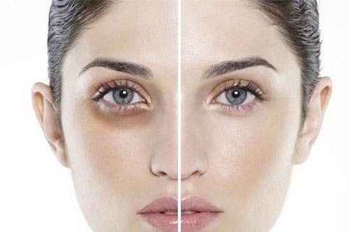Tạm biệt quầng thâm mắt hiệu quả bằng những phương pháp đơn giản