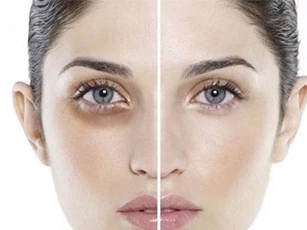 Tạm biệt quầng thâm mắt hiệu quả bằng những phương pháp đơn giản