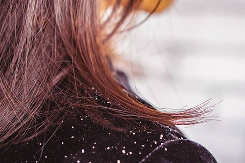 Trị gàu tại nhà mà không cần dùng hóa chất