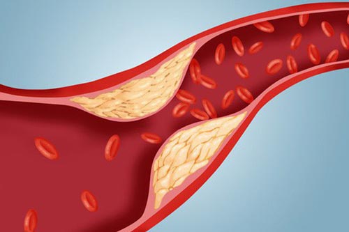 Làm sạch mạch máu chỉ bằng cách dùng tỏi và chanh