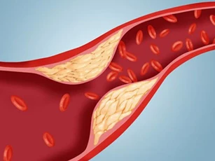 Làm sạch mạch máu chỉ bằng cách dùng tỏi và chanh