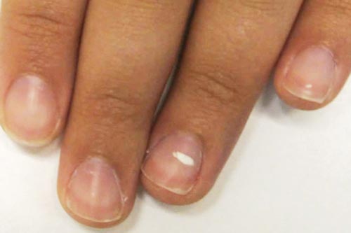 Sự thật về đốm trắng trên móng tay bạn phải biết?