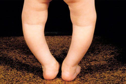 3 dấu hiệu cho biết bé có chiều cao vượt trội, 2 dấu hiệu mẹ nên cẩn trọng bé dễ dị tật ở chân