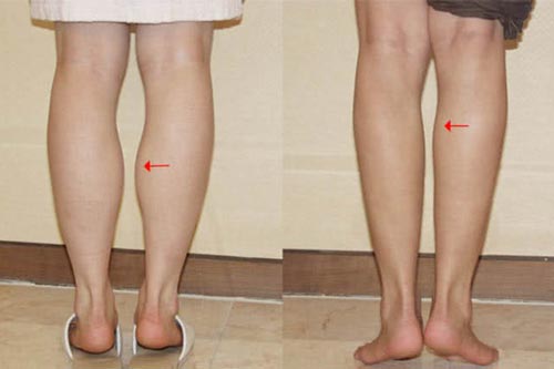 Giảm mỡ bắp chân không hề khó như bạn nghĩ