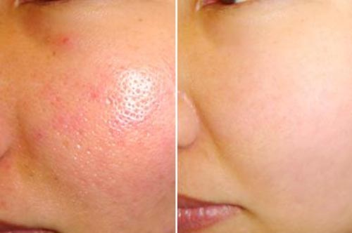 Lỗ chân to như sẹo rỗ cũng khỏi chỉ trong vài ngày