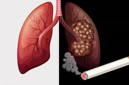 Thanh lọc phổi dành riêng cho người hút thuốc lá