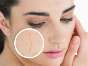 Khắc phục tình trạng da khô vô cùng hiệu quả