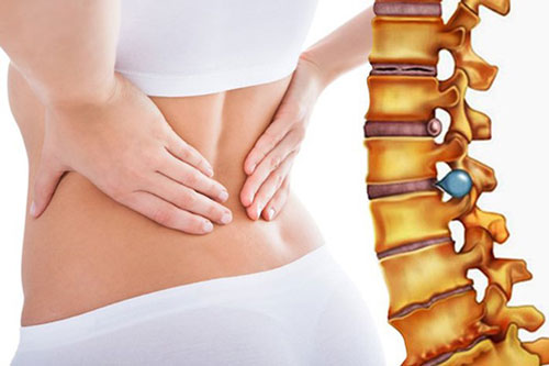 3 dấu hiệu cảnh báo bạn bị thoát vị đĩa đệm