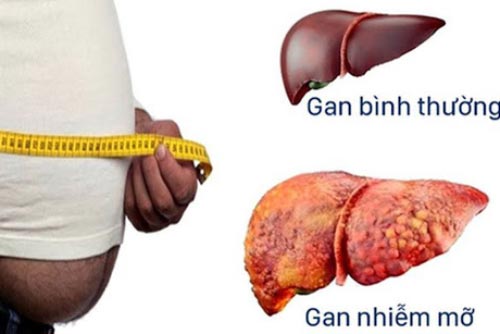 Những điều bạn cần biết về bệnh gan nhiễm mỡ?
