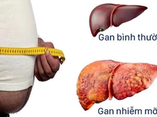 Những điều bạn cần biết về bệnh gan nhiễm mỡ?