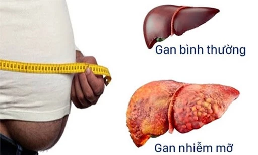 Những điều bạn cần biết về bệnh gan nhiễm mỡ?