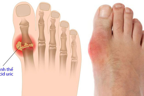 Không muốn bị bệnh gout thì hãy hạn chế thực phẩm này