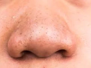 2 cách trị mụn đầu đen có thể bạn chưa biết