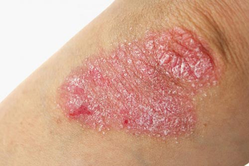 Những điều bạn bắt buộc phải biết về bệnh vảy nến