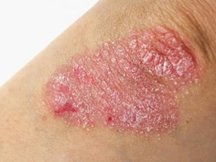 Những điều bạn bắt buộc phải biết về bệnh vảy nến