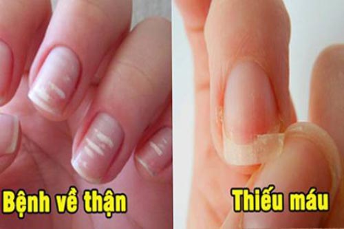 Nhìn màu móng tay bắt bệnh, những dấu hiệu cực kỳ nguy hiểm chớ dại bỏ qua