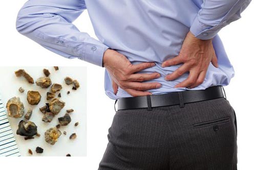 3 điều phải biết để tránh sỏi thận