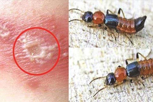 Mẹo giúp phòng kiến ba khoang hiệu quả nhất