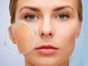3 cách xóa sẹo tại nhà rẻ tiền nhất