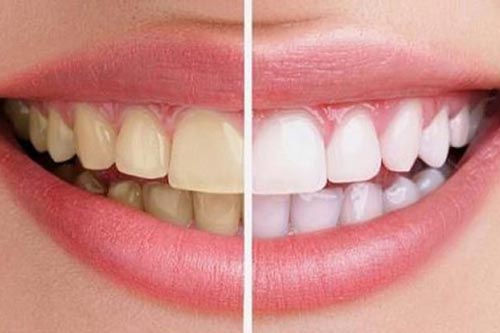 Nguyên liệu bạn đang bỏ đi nhưng tẩy trắng răng cực tốt