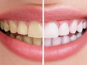 Nguyên liệu bạn đang bỏ đi nhưng tẩy trắng răng cực tốt