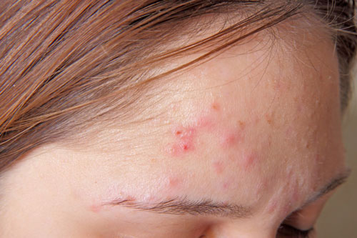 4 công thức trị mụn trứng cá tại nhà ai cũng làm được