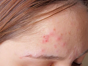4 công thức trị mụn trứng cá tại nhà ai cũng làm được