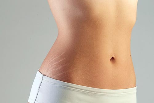 Mách bạn cách chữa rạn da hiệu quả ở tuổi dậy thì