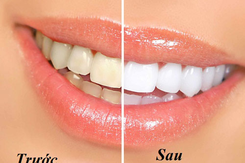 Mẹo nhỏ giúp bạn loại bỏ vết ố vàng trên răng