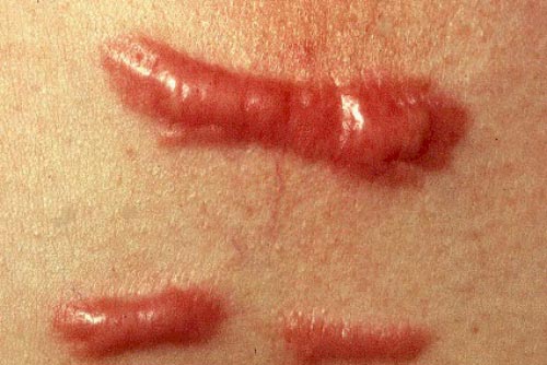 Có thật ăn rau muống bị sẹo lồi?