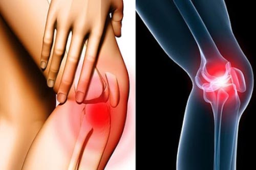 Bài thuốc dân gian ‘rẻ như cho’ lại là thần dược chữa bệnh viêm khớp được nhiều người truyền tai