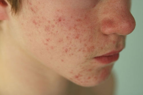 4 cách trị mụn trứng cá an toàn từ thiên nhiên