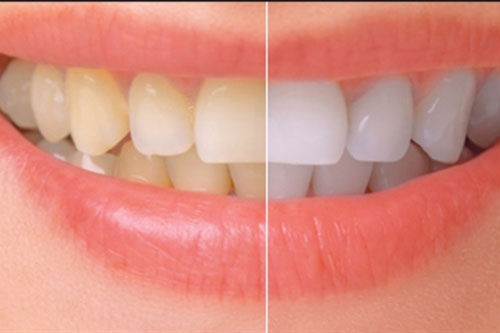 Giúp bạn làm trắng răng tại nhà với 2 công thức đơn giản