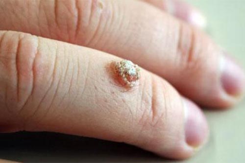 Những điều bạn phải biết về mụn cóc