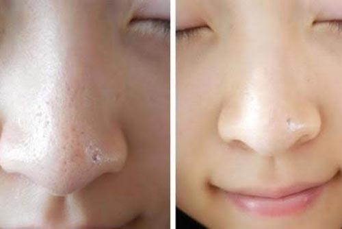 4 mẹo se lỗ chân lông tại nhà