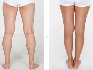 Cách làm giảm mỡ đùi cực dễ mà phụ nữ nên biết
