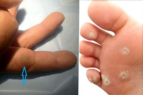 3 cách loại bỏ vết chai tay, chân