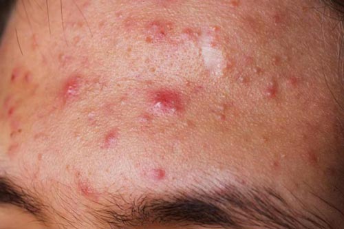 Biết điều này bạn sẽ không lo mụn trên trán