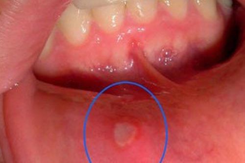 Trị nhiệt miệng thần tốc tại nhà bạn phải biết