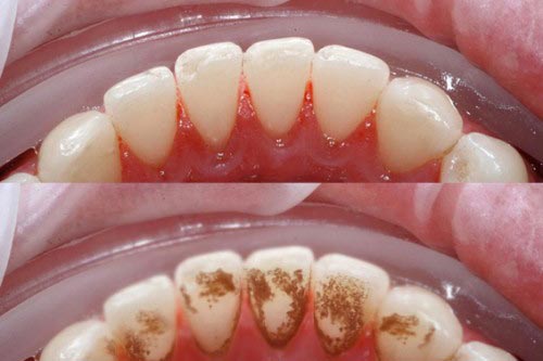 2 cách lấy cao răng đơn giản bạn cần ghi nhớ ngay hôm nay