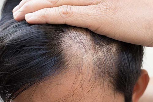 Mảng đầu hói vẫn có thể kích thích tóc mọc lên