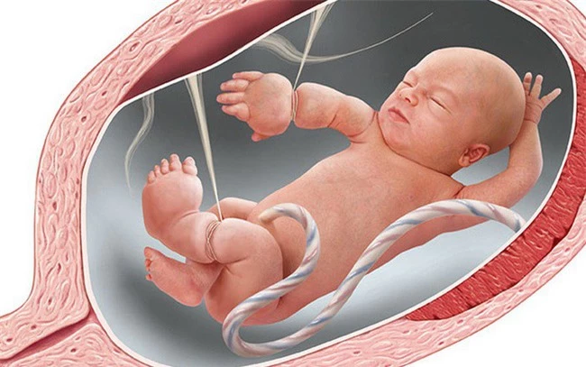Các dải sợi ối có thể quấn vào thai nhi gây ra hiện tượng vòng thắt bẩm sinh.